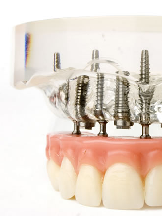 implant supported dentures